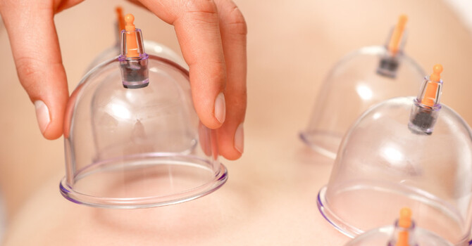 What is cupping? Is it a trend? image